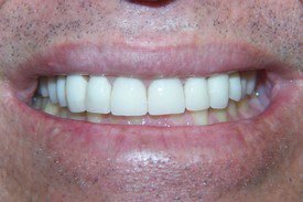 After treatment, case 1
