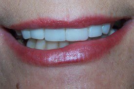 After treatment, case 2