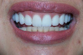 After treatment, case 3