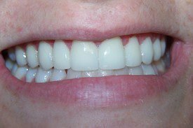 After treatment, case 4