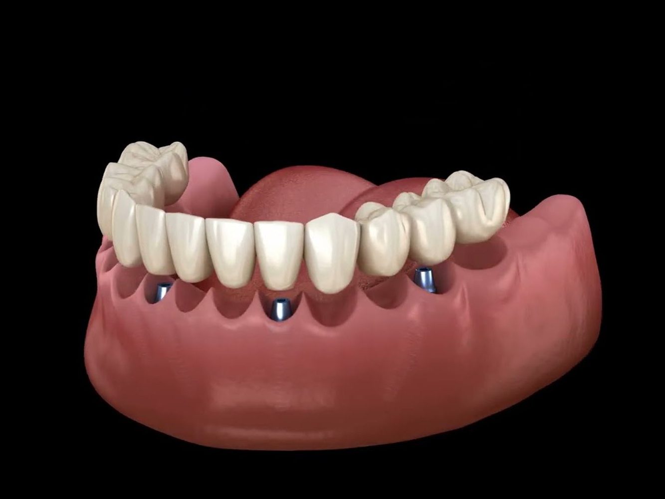 An illustration of a full lower arch of teeth supported on four implants