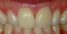 After: the gap restored with a single implant and porcelain crown