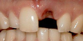 Before: a missing upper central incisor
