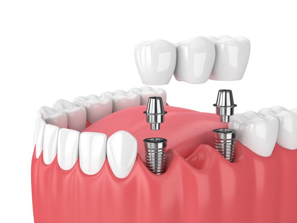 An illustration of an implant-supported bridge being placed on two implants