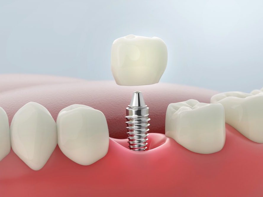 An illustration of a single dental implant and crown being placed in the jaw