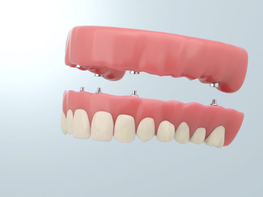 An illustration of a denture supported by implants in the jaw