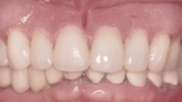 After upper and lower arch rehabilitation