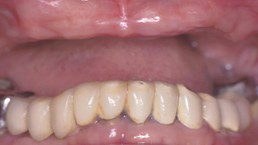 Before upper and lower arch rehabilitation